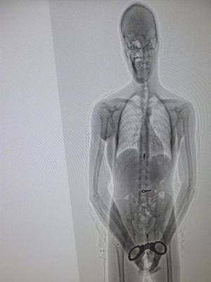 Scanner mostra a chave dentro do corpo do prisioneiro