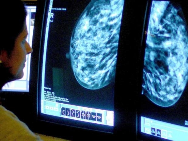 Entidades que combatem câncer de mama não recomendam uso de estatina e pedem mais estudos